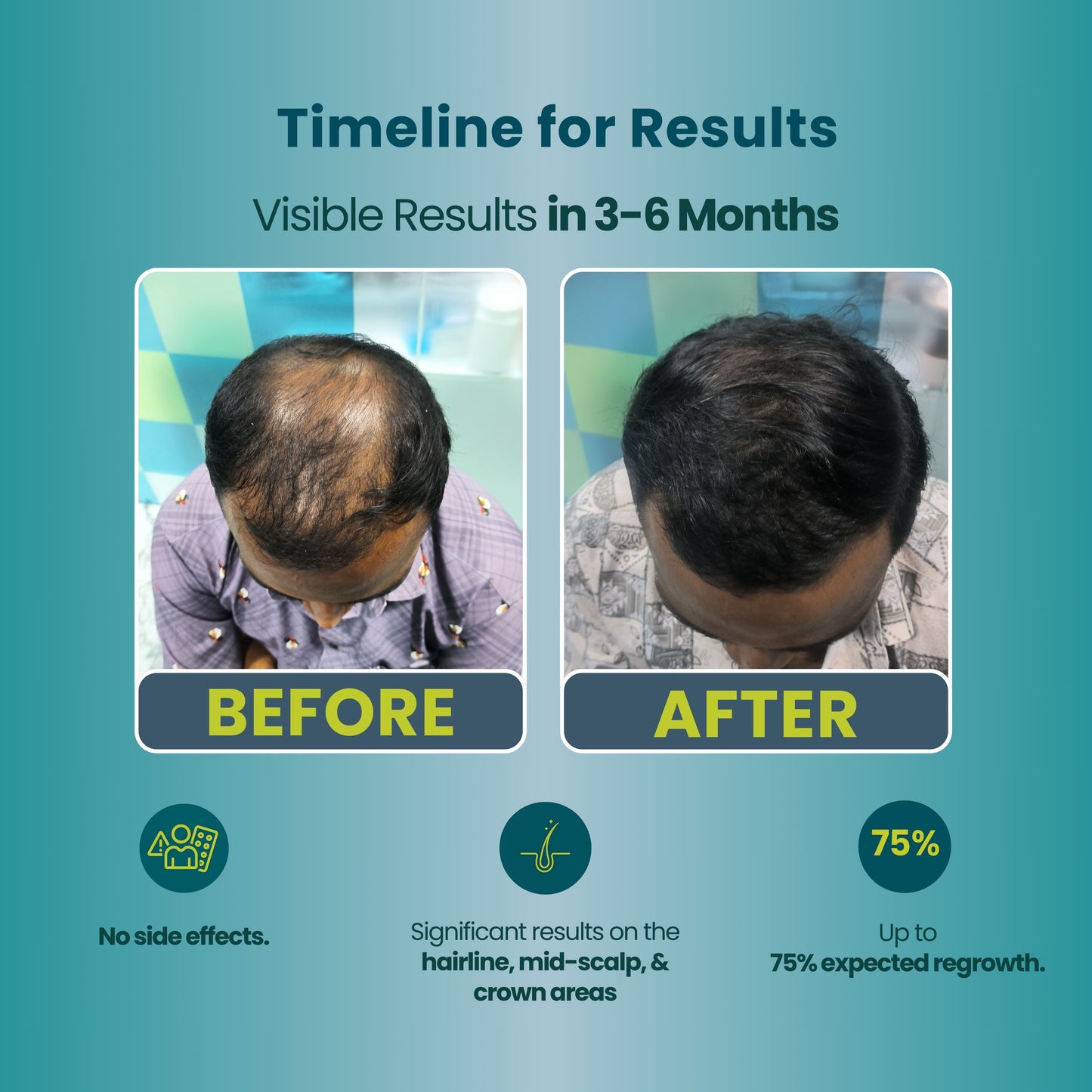 Essential( Pre- Advanced) Hair regrowth kit